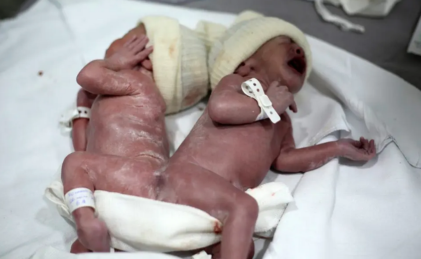 Bebês siameses nascidos no Hospital do Rocio, em Campo Largo. Foto: Divulgação/Hospital do Rocio